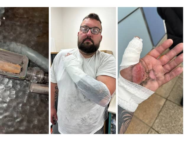 A lorry driver suffered horror injuries when an e-cigarette exploded in his hand.
Mike Calver, 38, was changing the battery on his device at home in Stoke-on-Trent, when it blew up.
His hand, beard and clothes were set on fire - while the scalding e-cigarette stuck to his hand.